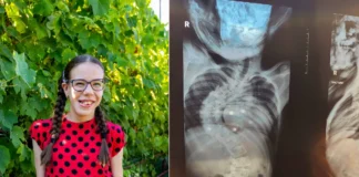 APEL UMANITAR. La doar 13 ani, Diana, o copilă din județul Bacău, luptă cu o scolioză severă. Două operații urgente îi pot schimba viața