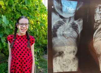 APEL UMANITAR. La doar 13 ani, Diana, o copilă din județul Bacău, luptă cu o scolioză severă. Două operații urgente îi pot schimba viața
