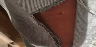 (FOTO) Fetiță de 13 ani atacată de câini, în drum spre școală, în centrul Bacăului. A ajuns de urgență la spital